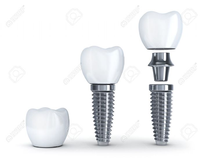 Implante Dental 3.5mm
